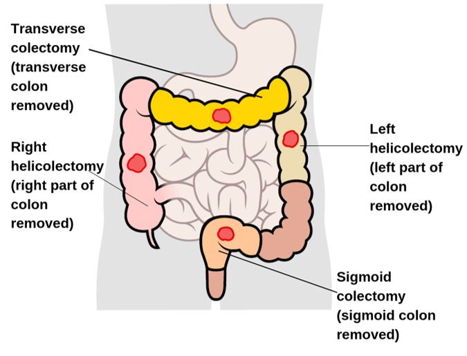 Types of surgery for colon cancer - Cancer Care