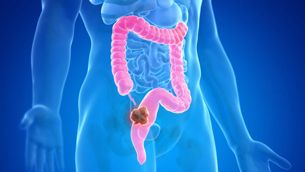 Understanding Colorectal Cancer: Stages and Their Significance