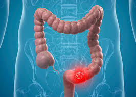 The Warning Signs: Common Symptoms of Colon Cancer
